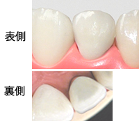 オールセラミッククラウン