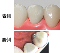 ハイブリッドセラミッククラウン